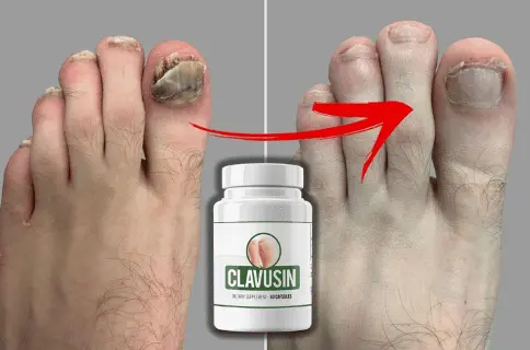 Clavusin Toenail Fungus Treatment